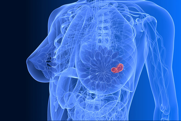 Meme Kanseri Tedavisi