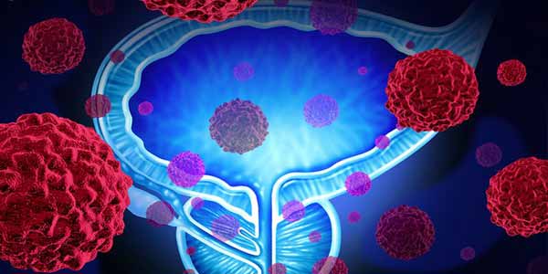Prostat Kanseri Tedavisi