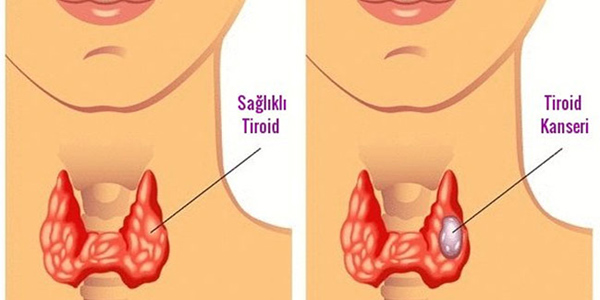 Tiroid Kanseri Tedavisi