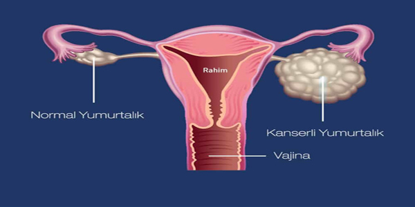 Yumurtalık Kanseri Tedavisi